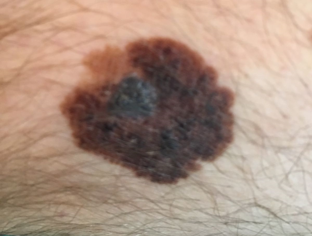 Melanoma